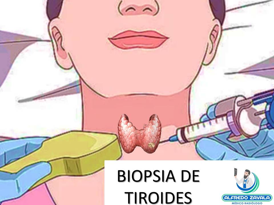 Biopsia de tiroides guiada por ultrasonido en Querétaro 
