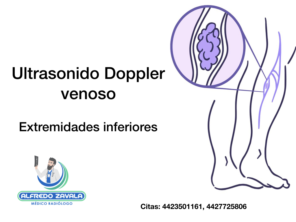 Ultrasonido Doppler venoso de extremidades inferiores en Querétaro  