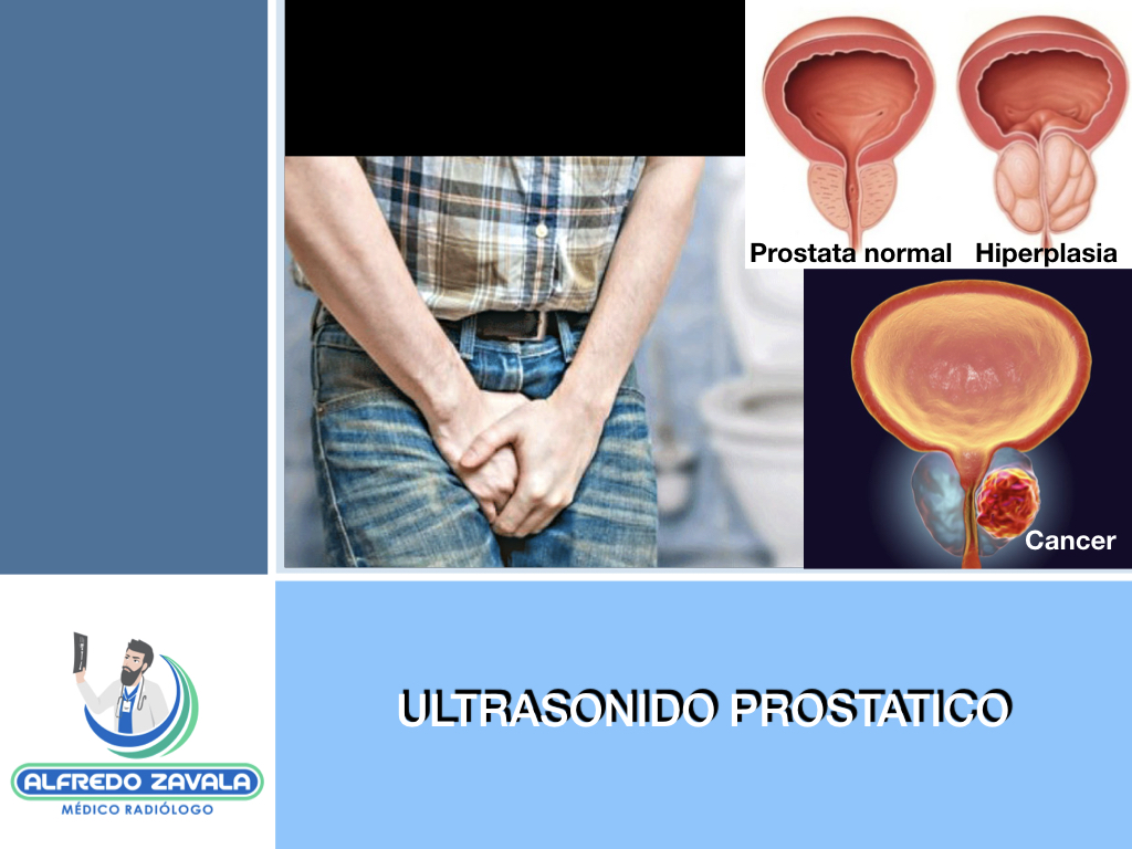 cancer de prostata ultrasonido