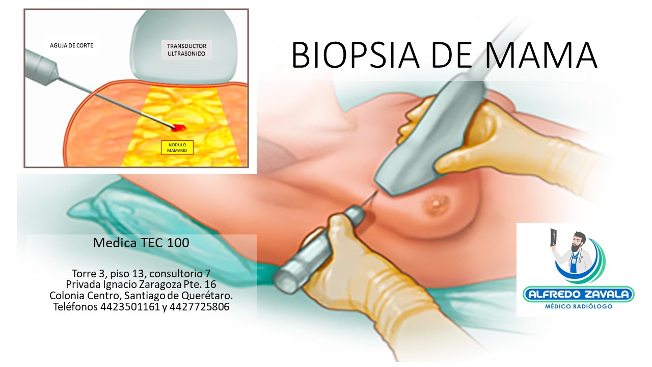 Biopsia de mama guiada por ultrasonido en Querétaro.  
