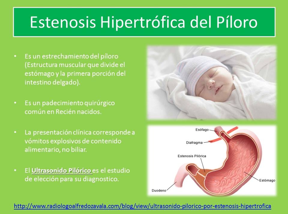 Ultrasonido Pilórico por Estenosis Hipertrófica del Píloro  